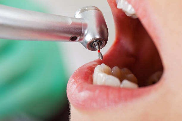 Best Emergency Root Canal Treatment in Shelburn, IN